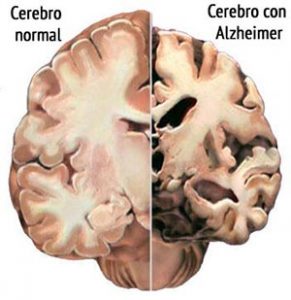 Alzheimer_causas